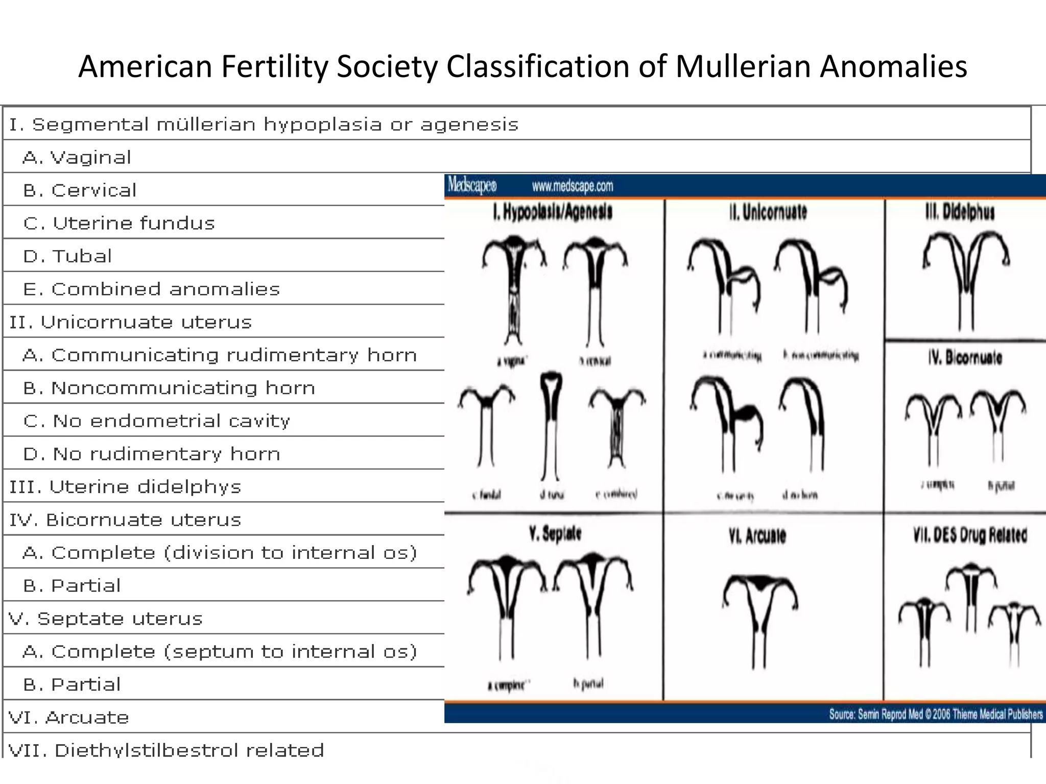 Mullerian anomalies | PPT