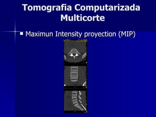 Maximun Intensity proyection (MIP) Tomografia Computarizada  Multicorte 