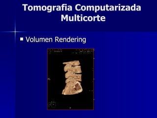 Volumen Rendering Tomografia Computarizada  Multicorte 