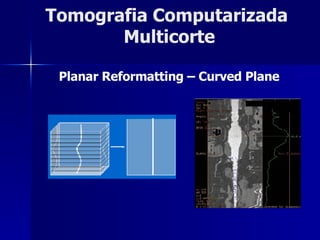 Tomografia Computarizada  Multicorte Planar Reformatting – Curved Plane 