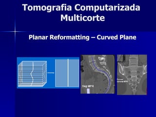 Tomografia Computarizada  Multicorte Planar Reformatting – Curved Plane 
