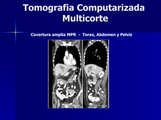 Tomografia Computarizada  Multicorte Covertura amplia MPR  -  Torax, Abdomen y Pelvis 