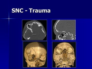 SNC - Trauma 