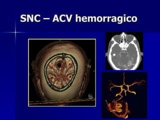 SNC – ACV hemorragico 