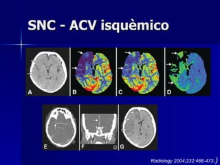 SNC - ACV isquèmico Radiology 2004;232:466-473 .) 