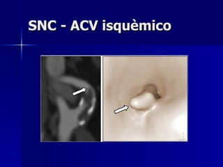 SNC - ACV isquèmico 