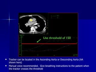 Tracker can be located in the Ascending Aorta or Descending Aorta (AA shown here) Manual voice recommended.  Give breathing instructions to the patient when the tracker crosses the threshold Use threshold of 150 
