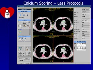 Calcium Scoring – Less Protocols 