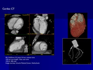 40 x 0.625mm; 0.2 pitch, 0.4 sec rotation time 120 mm scan length, 12sec scan time 120 kV, 300 mAs Image courtesy: Utrecht Medical Center, Netherlands Cardiac CT 