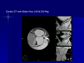Cardiac CT with Globe View, 3-D & 2-D Map 