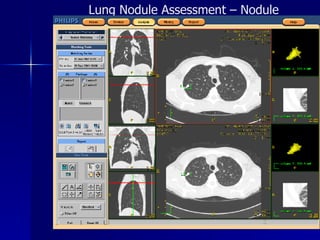 Lung Nodule Assessment – Nodule Matching 