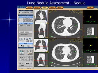 Lung Nodule Assessment – Nodule Matching 