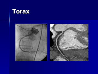 Torax 