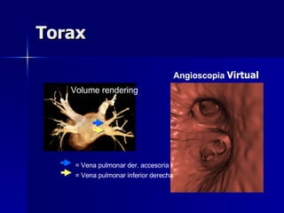 Torax Angioscopia  Virtual Right Volume rendering = Vena pulmonar der. accesoria = Vena pulmonar inferior derecha 
