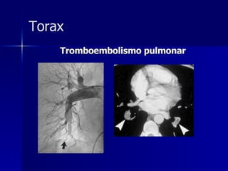 Tromboembolismo pulmonar Torax 