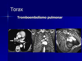 Tromboembolismo pulmonar Torax 