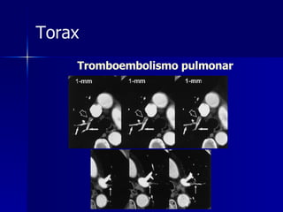 Tromboembolismo pulmonar Torax 