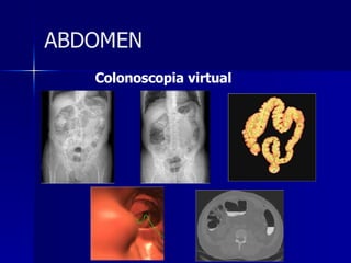 Colonoscopia virtual ABDOMEN 