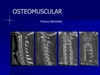Fractura Odontoides OSTEOMUSCULAR 