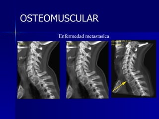 Enfermedad metastasica OSTEOMUSCULAR 