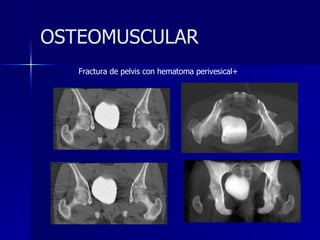 Fractura de pelvis con hematoma perivesical+  OSTEOMUSCULAR 