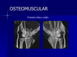 Fractura ulna y radio OSTEOMUSCULAR 