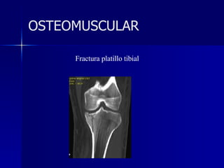 Fractura platillo tibial OSTEOMUSCULAR 