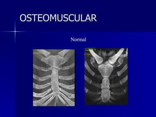 Normal OSTEOMUSCULAR 
