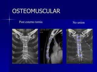 Post esterno tomia No union OSTEOMUSCULAR 
