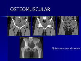 Quiste oseo aneurismatico OSTEOMUSCULAR 