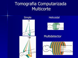Simple Helicoidal Multidetector Tomografia Computarizada  Multicorte 
