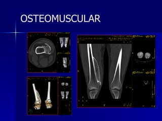 OSTEOMUSCULAR 
