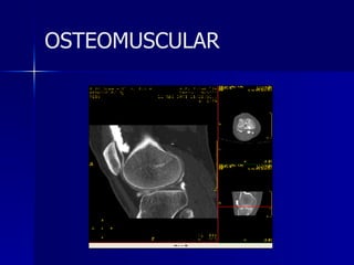OSTEOMUSCULAR 