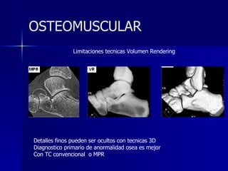 OSTEOMUSCULAR Detalles finos pueden ser ocultos con tecnicas 3D Diagnostico primario de anormalidad osea es mejor Con TC convencional  o MPR Limitaciones tecnicas Volumen Rendering 