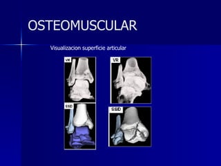 OSTEOMUSCULAR Visualizacion superficie articular 
