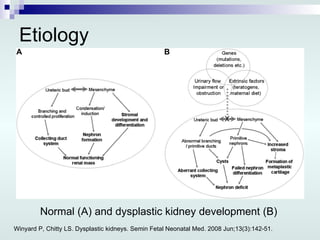Etiology Normal (A) and dysplastic kidney development (B) Winyard P, Chitty LS. Dysplastic kidneys. Semin Fetal Neonatal Med. 2008 Jun;13(3):142-51. 
