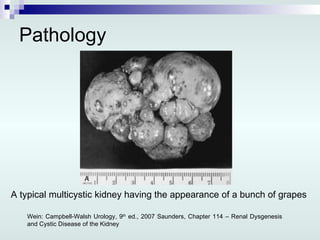 Pathology A typical multicystic kidney having the appearance of a bunch of grapes Wein: Campbell-Walsh Urology, 9 th  ed., 2007 Saunders, Chapter 114 – Renal Dysgenesis and Cystic Disease of the Kidney 