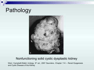 Pathology Nonfunctioning solid cystic dysplastic kidney  Wein: Campbell-Walsh Urology, 9 th  ed., 2007 Saunders, Chapter 114 – Renal Dysgenesis and Cystic Disease of the Kidney 
