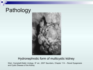 Pathology Wein: Campbell-Walsh Urology, 9 th  ed., 2007 Saunders, Chapter 114 – Renal Dysgenesis and Cystic Disease of the Kidney Hydronephrotic form of multicystic kidney  