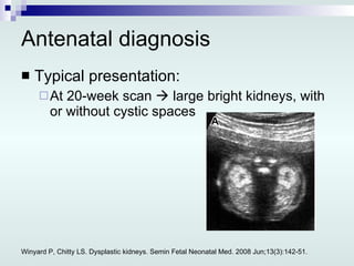 Antenatal diagnosis Typical presentation: At 20-week scan    large bright kidneys, with or without cystic spaces Winyard P, Chitty LS. Dysplastic kidneys. Semin Fetal Neonatal Med. 2008 Jun;13(3):142-51. 