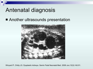 Antenatal diagnosis Another ultrasounds presentation Winyard P, Chitty LS. Dysplastic kidneys. Semin Fetal Neonatal Med. 2008 Jun;13(3):142-51. 