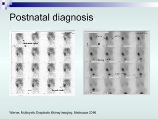 Postnatal diagnosis Wiener, Multicystic Dysplastic Kidney Imaging. Medscape 2010 