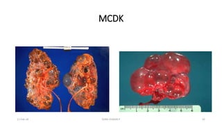 Mcdk Ras Multi cystic dysplastic kidney (renal dysplasia) | PPTX