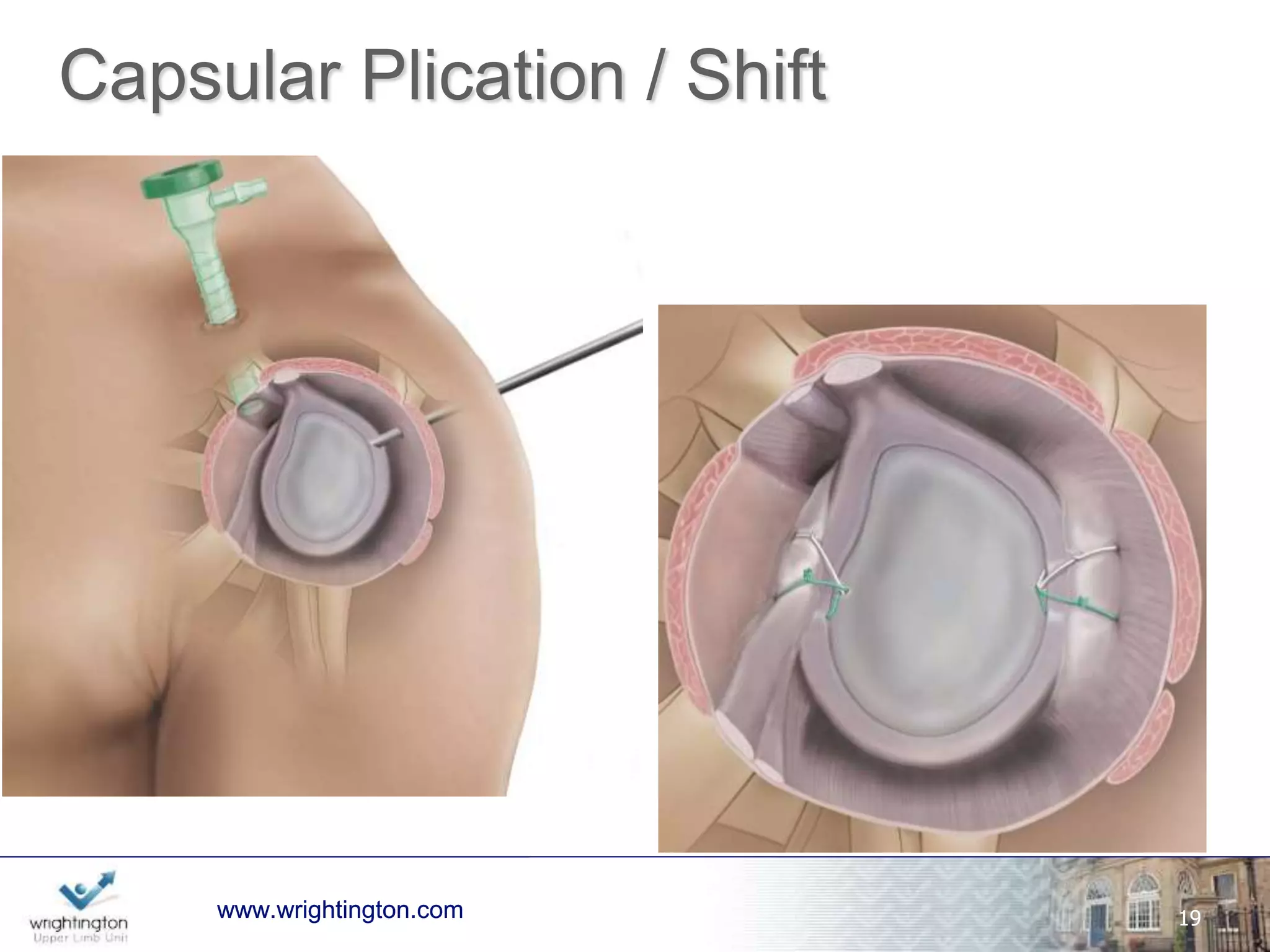 Capsular Plication Results 
Arthroscopic 88-94% success at 2-5yrs Gartsmann 
Open 
94% good/excellent at 5yrs Bigliani 
59% good/excellent 
83% satisfactory 
Hamada 
wwwwww.w.wrigrhigtinhgttionng.ctoomn.com 25 
 