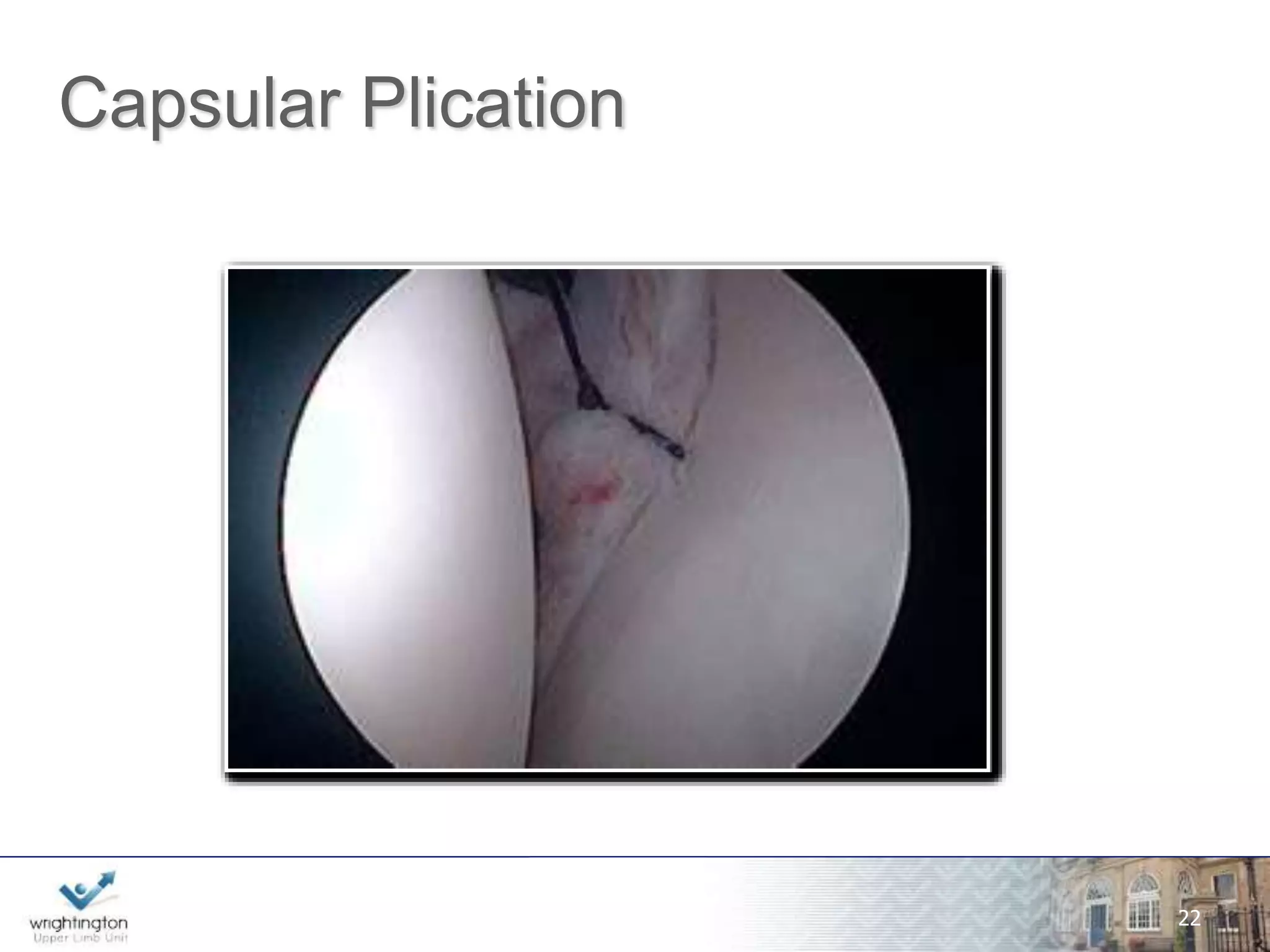 Arthroscopic Plication Audit 
Clinical outcome of arthroscopic capsular 
plication for atraumatic instability (Stanmore II) 
of the shoulder by a single surgeon, with >12 
month follow-up. 
wwwwww.w.wrigrhigtinhgttionng.ctoomn.com 
26 
Tablot, Carter & Funk, BESS 2012 
 
