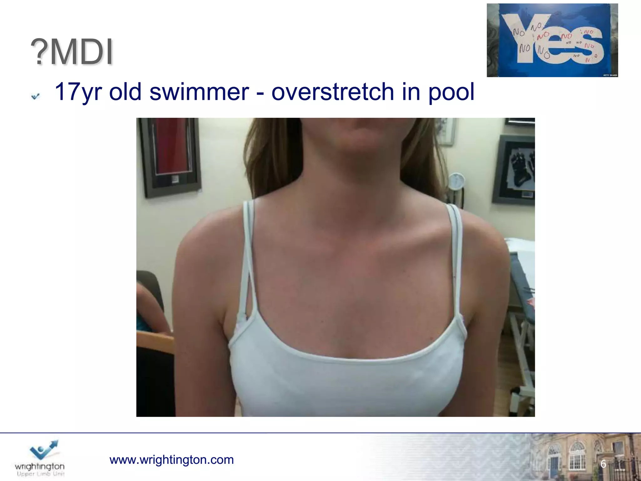 MDI - Definitions? 
1. Shoulder Instability in patients who have generalised 
looseness of the ligaments of the shoulder [Web Dictionary] 
2. Generalised looseness of the shoulder joint 
3. Abnormal excursion of the humeral head on the glenoid in all 
directions [Neer] 
4. Instability in TWO directions [1,2,3,4] 
5. Instability in THREE directions [5,6,7] 
6. Motor Control Trouble - the less surgery the best 
wwwwww.w.wrigrhigtinhgttionng.ctoomn.com 
(Olivier Gagey - 20min ago!) 
6 
 