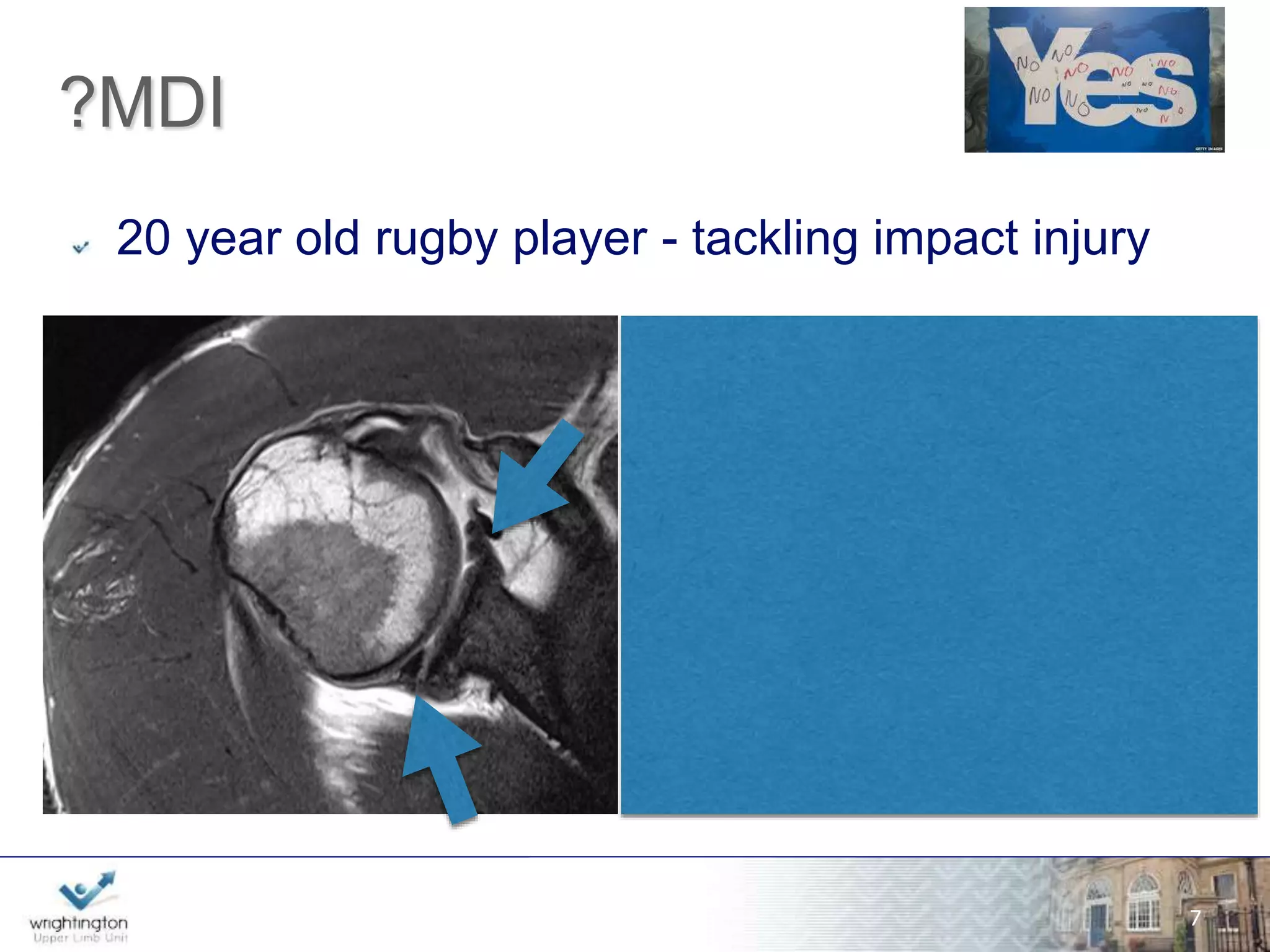wwwwww.w.wrigrhigtinhgttionng.ctoomn.com 
nferior 
shift 
eh 
abilitation 
ilateral 
ultidirection 
al 
traumatic 
Range AMBRI 
TUBS 
7 
urgery 
ankart 
nidirectional 
umatic 
ra 
 