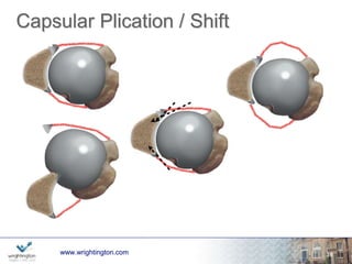 Capsular Plication 
wwwwww.w.wrigrhigtinhgttionng.ctoomn.com 
20 
 