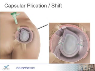 Capsular Plication Results 
Arthroscopic 88-94% success at 2-5yrs Gartsmann 
Open 
94% good/excellent at 5yrs Bigliani 
59% good/excellent 
83% satisfactory 
Hamada 
wwwwww.w.wrigrhigtinhgttionng.ctoomn.com 25 
 