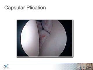 Arthroscopic Plication Audit 
Clinical outcome of arthroscopic capsular 
plication for atraumatic instability (Stanmore II) 
of the shoulder by a single surgeon, with >12 
month follow-up. 
wwwwww.w.wrigrhigtinhgttionng.ctoomn.com 
26 
Tablot, Carter & Funk, BESS 2012 
 